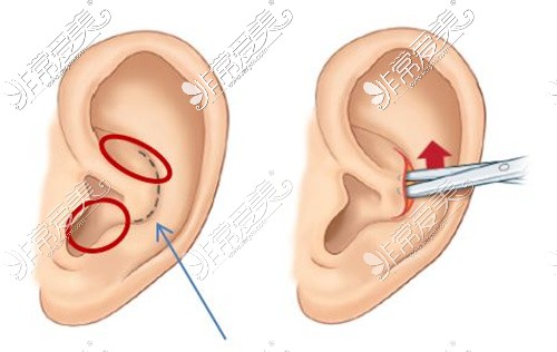 耳软骨隆鼻取骨部位