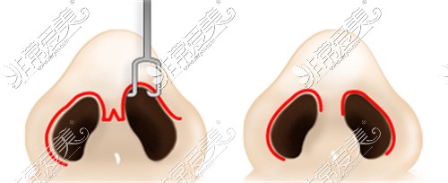 不同的鼻整形切口对比