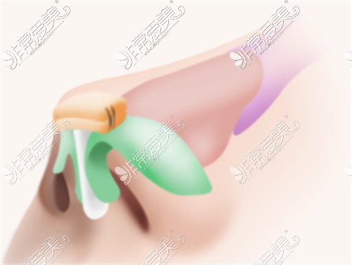 耳软骨鼻综合内部支架结构