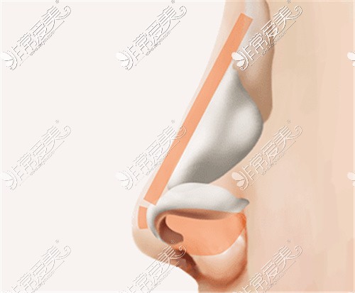 耳软骨鼻综合假体和软骨所在位置