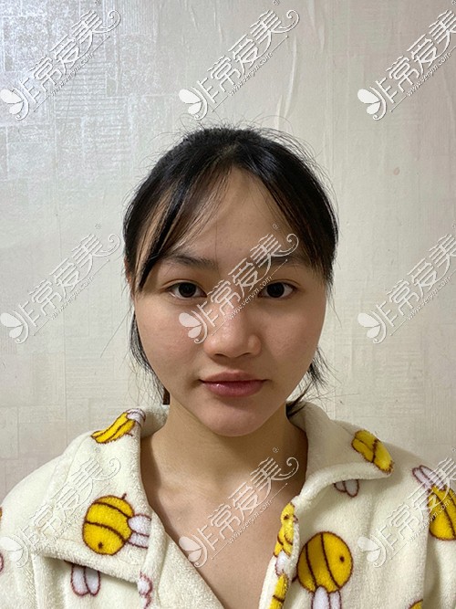 韩国拉菲安整形外科面部轮廓手术前
