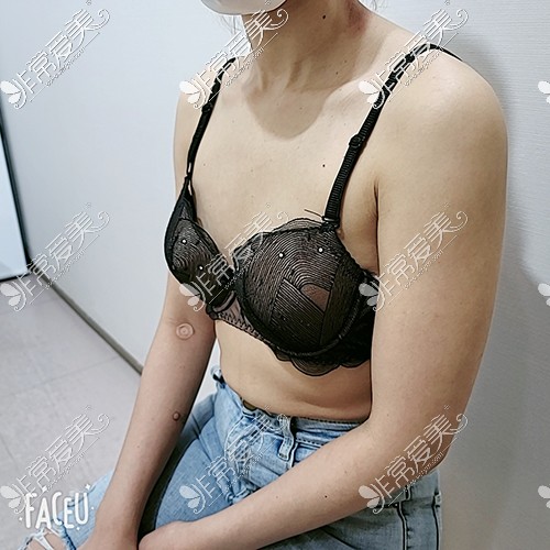 韩国拉菲安整形外科隆胸整形前