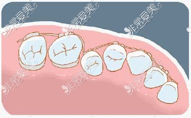 牙齿矫正漫画图