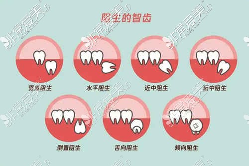 阻生的智齒問題