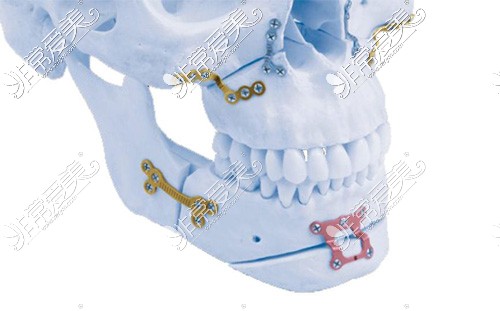 正颌手术模型