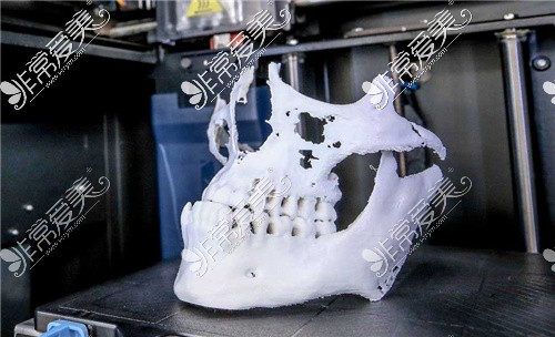 颌面手术3D打印模型