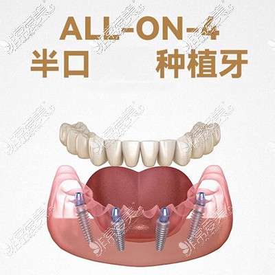 广州柏德口腔种植牙诊疗