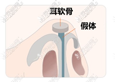 隆鼻鼻尖支架耳软骨和假体支撑