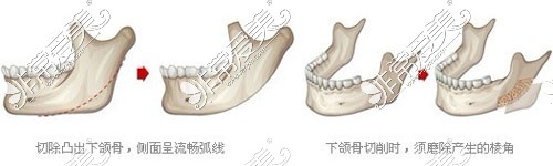 下颌角整形示意图