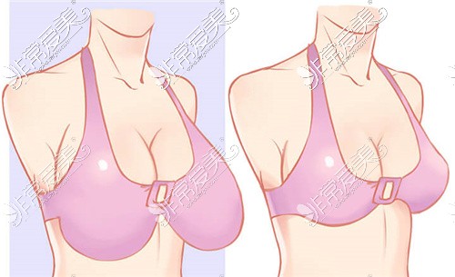 乳房下垂手术 缩小图片