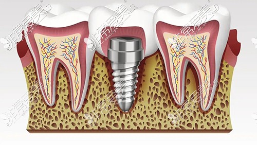 种植牙示意图