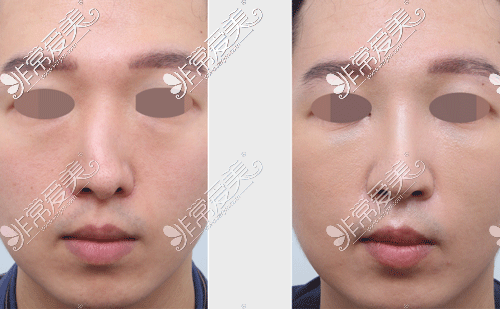 韩国星整形鼻子歪鼻修复前后图片