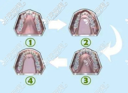 MRC儿童牙齿矫治器示意图