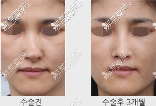 韩国星整形隆鼻修复前后图