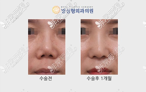 韩国星整形医院鼻子再次手术
