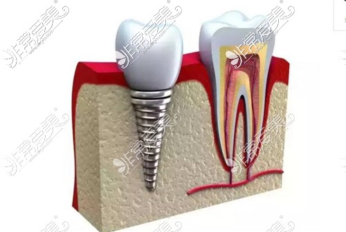 种植牙&健康牙机构对比图