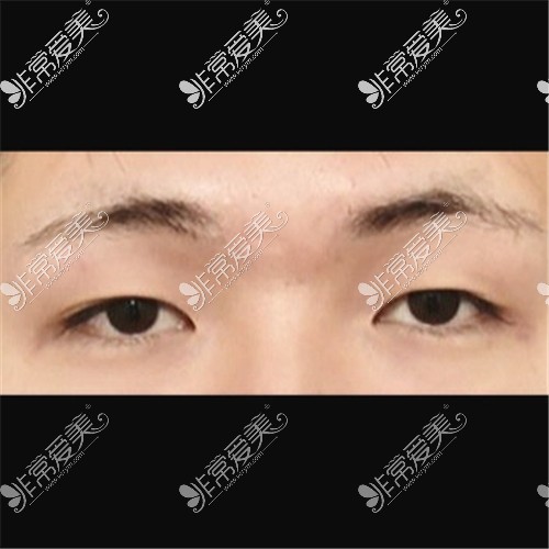 韩国ICON整形医院埋线双眼皮修复术前
