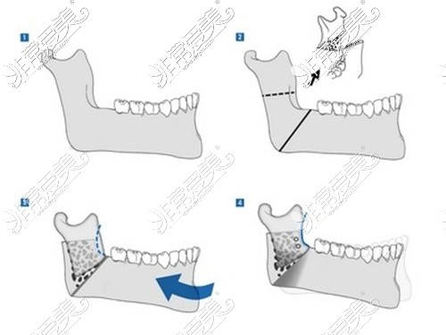 JSRO下颌线条调整截骨术