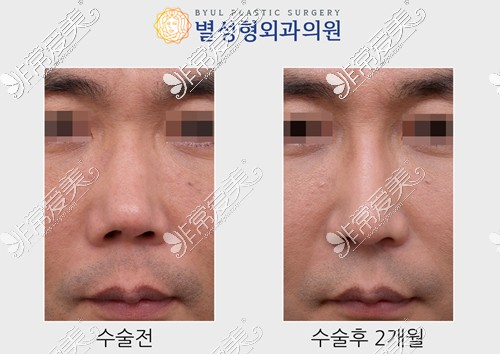 韩国星整形外科男士鼻修复前后对比图