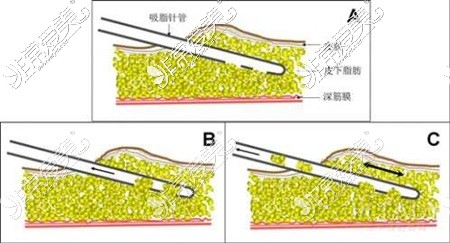 脂肪層示意圖