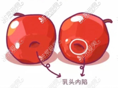 乳腺癌手术切口设计图图片