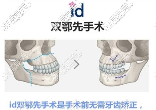 韩国ID医院双鄂手术图