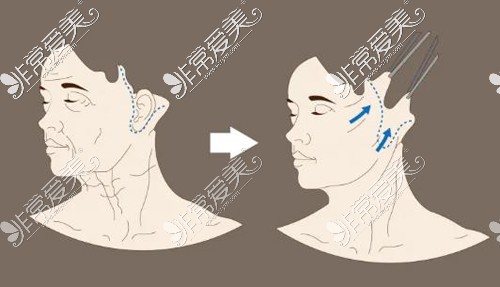 拉皮改善治疗前后对比展示