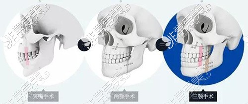 南京双鄂手术费用是多少?公布南京能做双鄂手术的医院排名