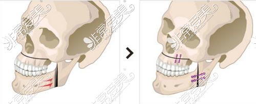 双鄂手术示意图