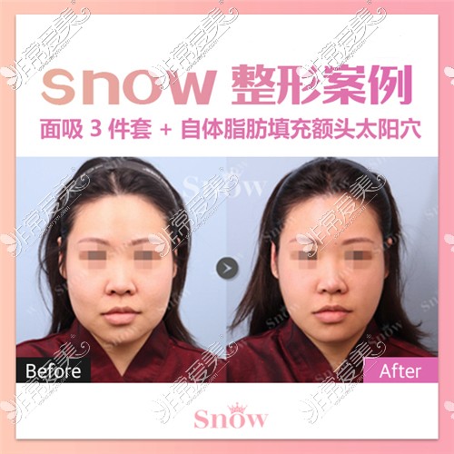 韩国Snow整形外科面部吸脂三件套对比