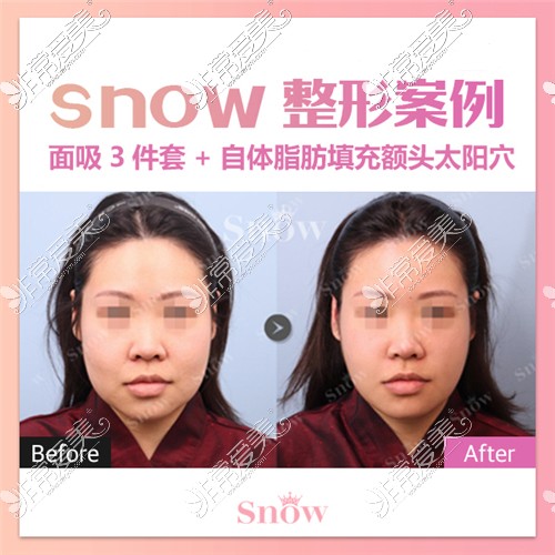 韓國Snow整形外科面部吸脂三件套對比