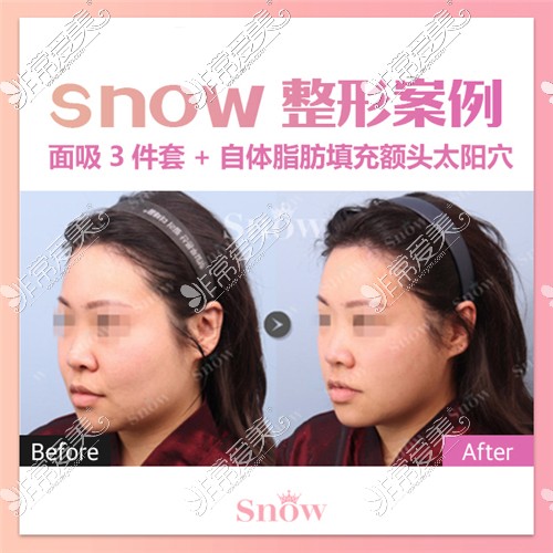 韓國Snow整形外科面部吸脂三件套前后圖