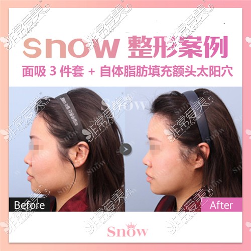 韩国Snow整形外科面部吸脂三件套对比图
