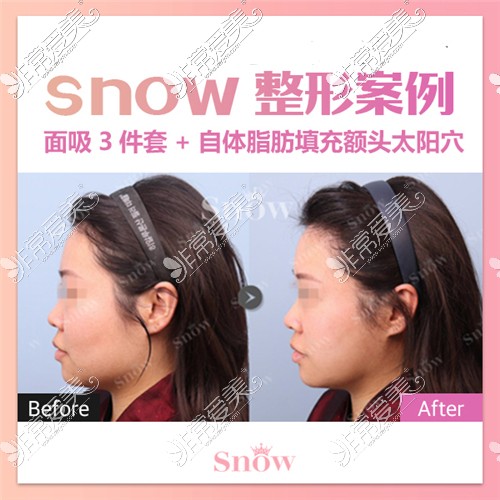 韓國Snow整形外科面部吸脂三件套對比圖