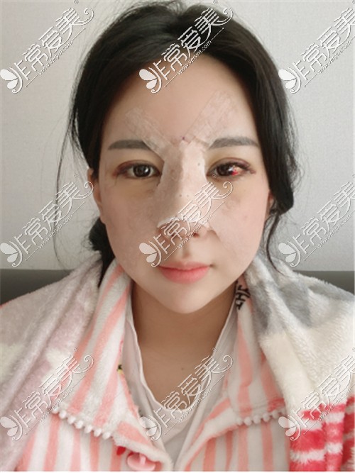 韩国DA整形医院眼鼻整形下巴吸脂恢复期