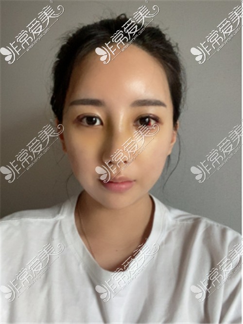 韩国DA整形医院眼鼻整形下巴吸脂术后一周