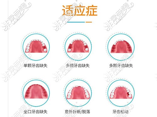 种植牙适应症图示