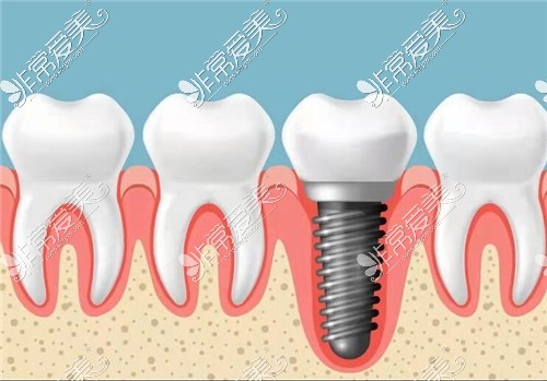 种植牙示意图