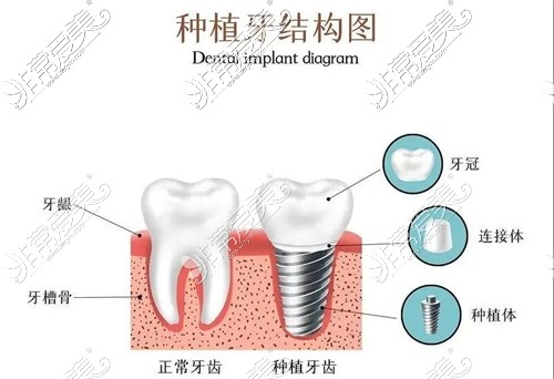 种植牙结构图