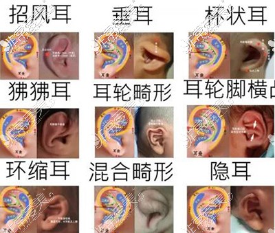 常见的耳朵畸形改善类型