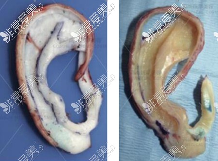 耳畸形改善治疗材料图