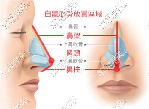 鼻部整形示意圖