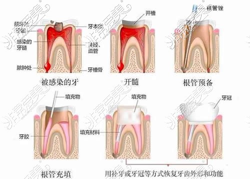 牙齿根管治疗示意图