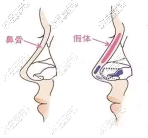 三亚鼻整形医生排名分享，这几位隆鼻鼻修复技术非常不错