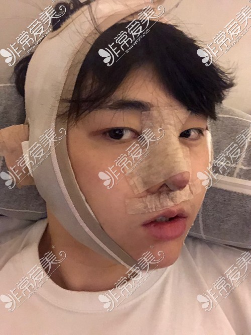 韩国脸本脸骨整形外科男子颧骨缩小+鼻整形术后1天