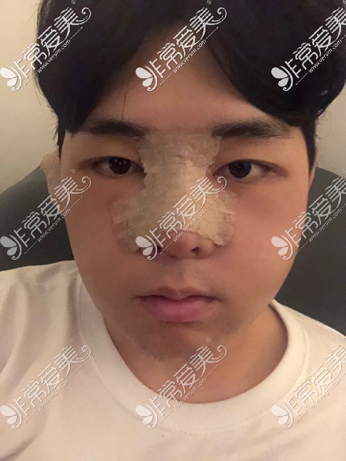 韩国脸本脸骨整形外科男子颧骨缩小+鼻整形术后3天