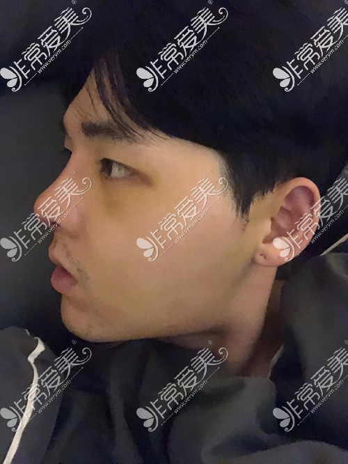 韩国脸本脸骨整形外科男子颧骨缩小+鼻整形术后5天