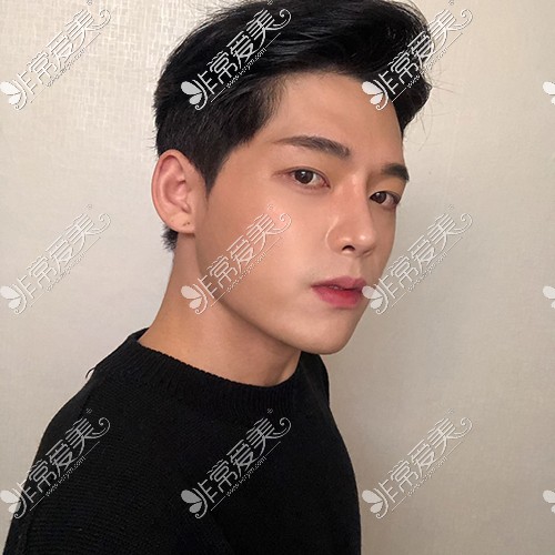 韩国脸本脸骨整形外科男子颧骨缩小+鼻整形术后10个月