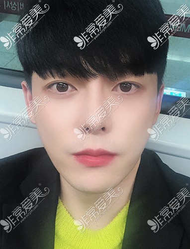 韩国脸本脸骨整形外科男子颧骨缩小+鼻整形术后1年1个月