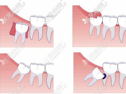 水平智齿拔除图解图片